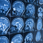 Head x-ray, brain in MRI