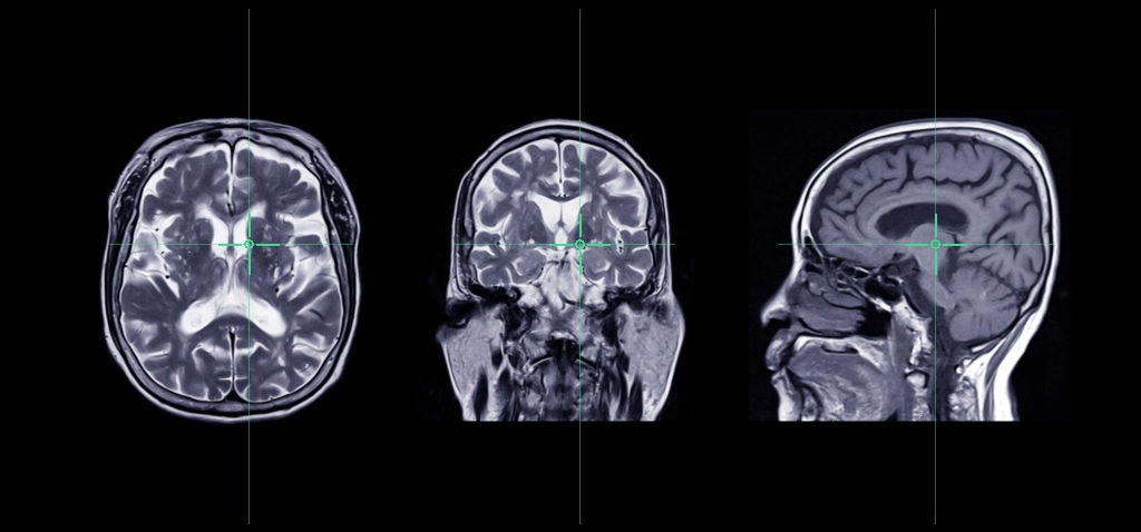 MRI of the brain in axial, coronal and sagittal planes — the imaging a navigation system reconstructs in 3D